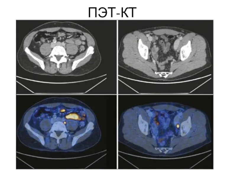 ПЭТ-КТ