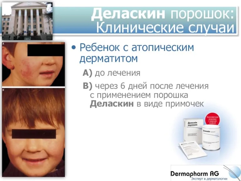 Деласкин порошок: Клинические случаи Ребенок с атопическим дерматитом А) до лечения B)