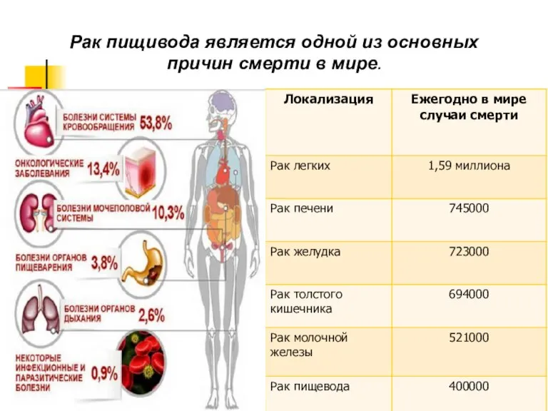 Рак пищивода является одной из основных причин смерти в мире.