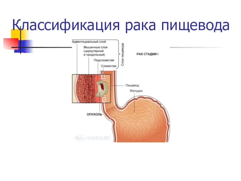 Классификация рака пищевода