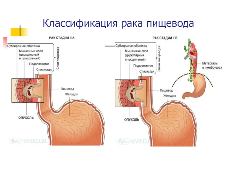 Классификация рака пищевода