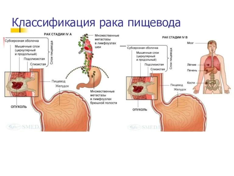 Классификация рака пищевода