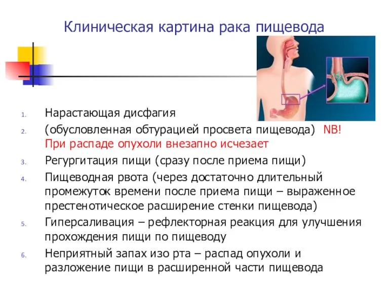 Клиническая картина рака пищевода Нарастающая дисфагия (обусловленная обтурацией просвета пищевода) NB! При