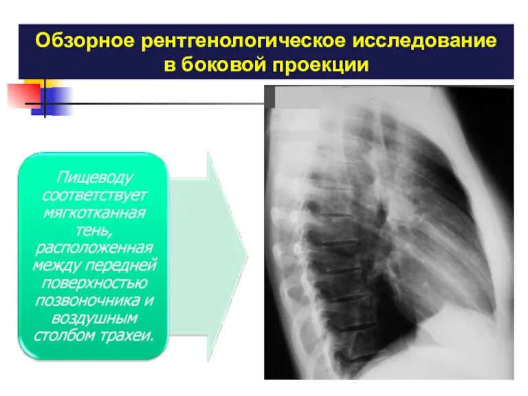 Обзорное рентгенологическое исследование в боковой проекции