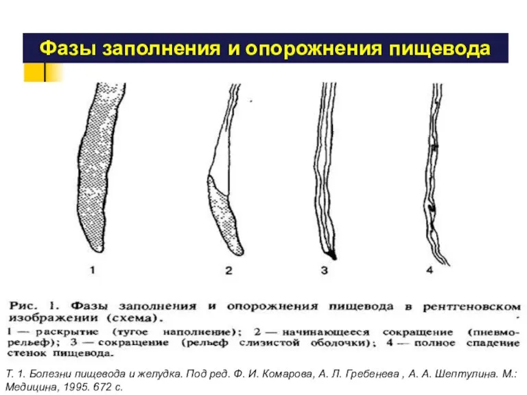 Фазы заполнения и опорожнения пищевода Т. 1. Болезни пищевода и желудка. Под