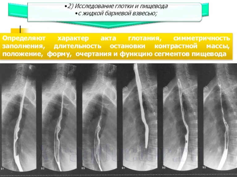 Определяют характер акта глотания, симметричность заполнения, длительность остановки контрастной массы, положение, форму,