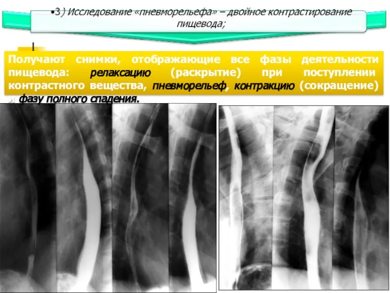 Получают снимки, отображающие все фазы деятельности пищевода: релаксацию (раскрытие) при поступлении контрастного