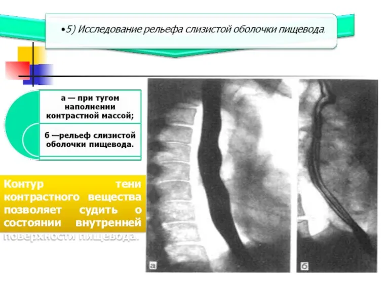 Контур тени контрастного вещества позволяет судить о состоянии внутренней поверхности пищевода.
