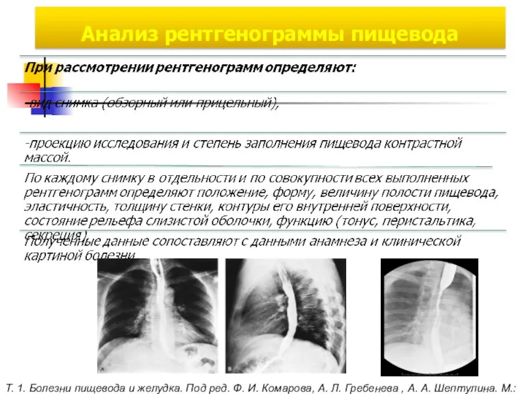 Анализ рентгенограммы пищевода Т. 1. Болезни пищевода и желудка. Под ред. Ф.