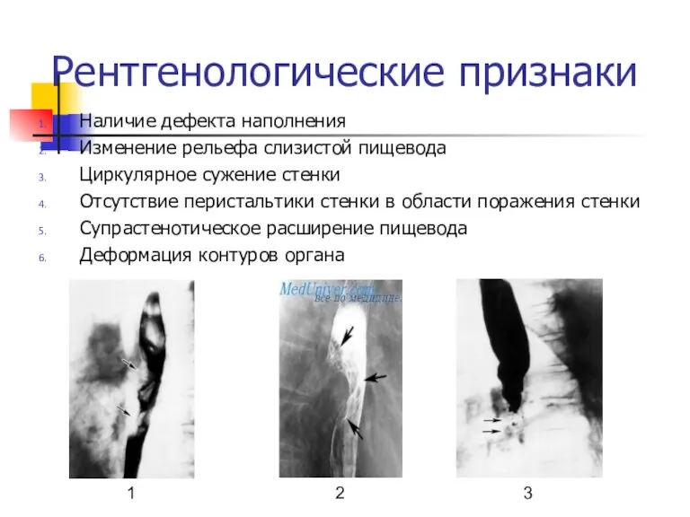 Рентгенологические признаки Наличие дефекта наполнения Изменение рельефа слизистой пищевода Циркулярное сужение стенки