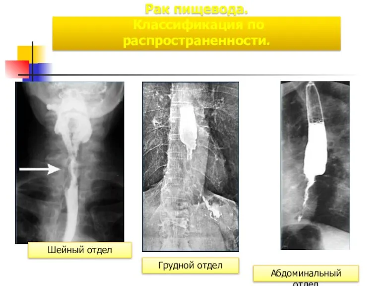 Рак пищевода. Классификация по распространенности. Шейный отдел Грудной отдел Абдоминальный отдел