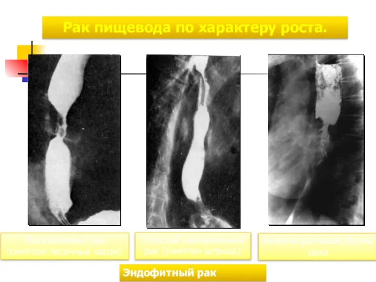 Рак пищевода по характеру роста. Эндофитный рак пищевода Изъязвленный рак (симптом песочных