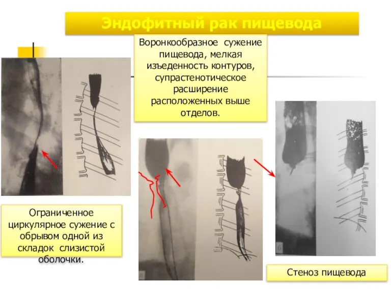 Эндофитный рак пищевода Ограниченное циркулярное сужение с обрывом одной из складок слизистой