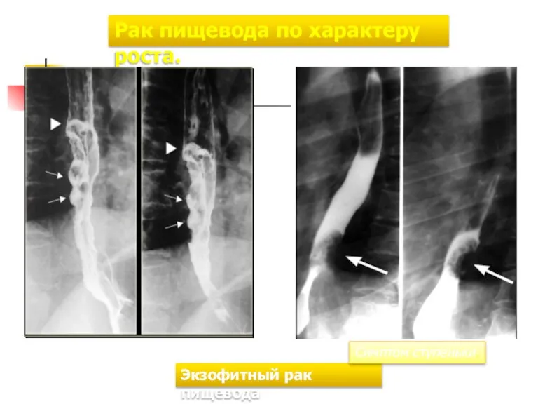 Рак пищевода по характеру роста. Экзофитный рак пищевода Симптом ступеньки.
