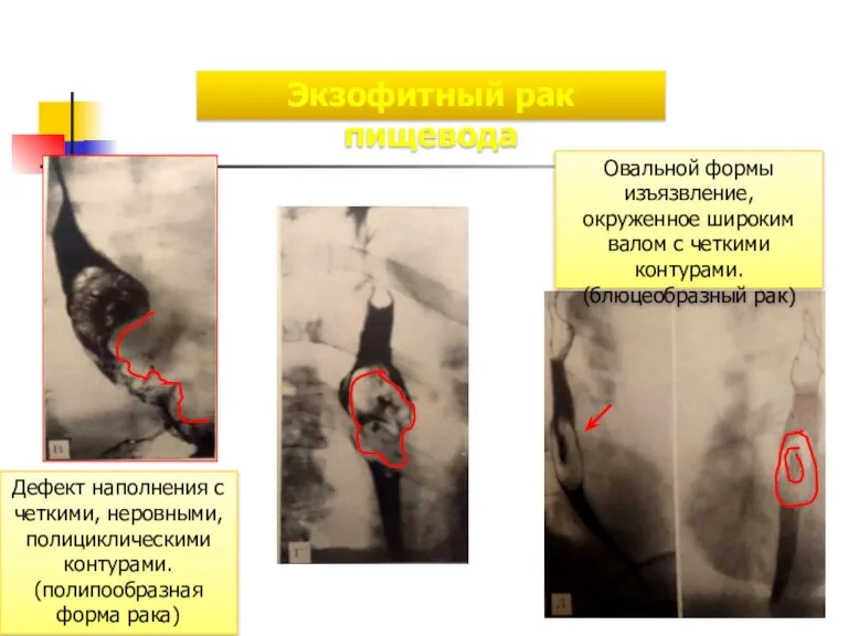 Экзофитный рак пищевода Дефект наполнения с четкими, неровными, полициклическими контурами. (полипообразная форма