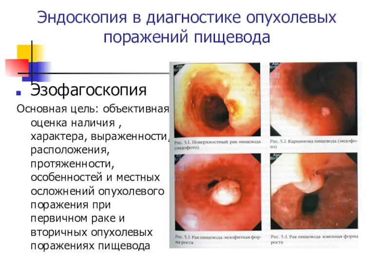 Эндоcкопия в диагностике опухолевых поражений пищевода Эзофагоскопия Основная цель: объективная оценка наличия