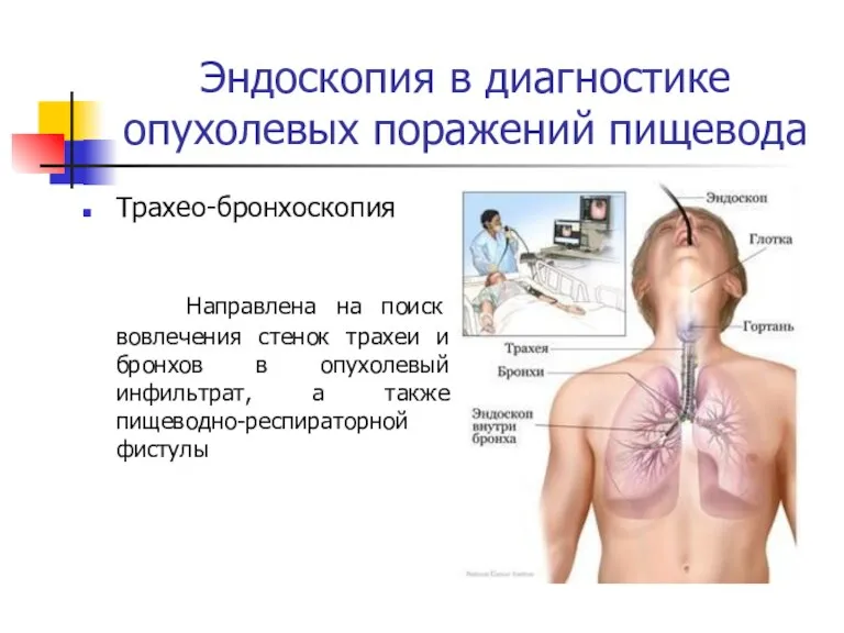 Эндоcкопия в диагностике опухолевых поражений пищевода Трахео-бронхоскопия Направлена на поиск вовлечения стенок