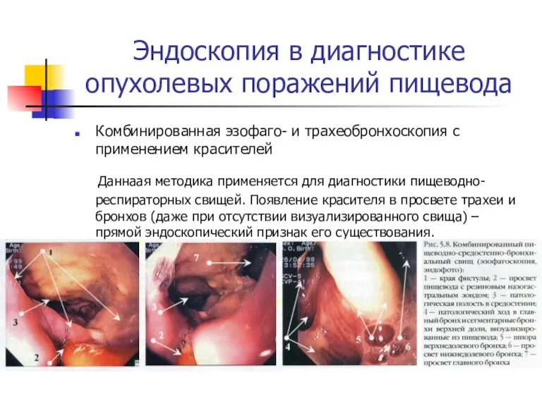 Эндоcкопия в диагностике опухолевых поражений пищевода Комбинированная эзофаго- и трахеобронхоскопия с применением