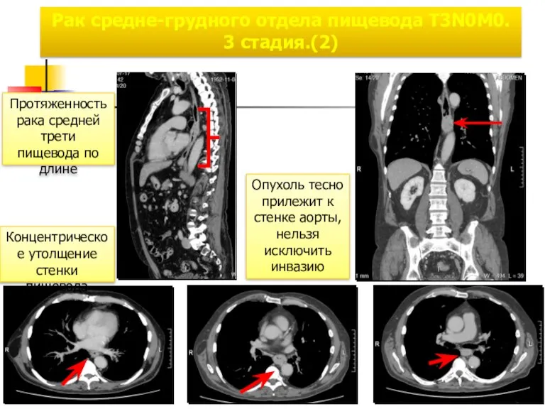 Рак средне-грудного отдела пищевода T3N0М0. 3 стадия.(2) Концентрическое утолщение стенки пищевода Опухоль