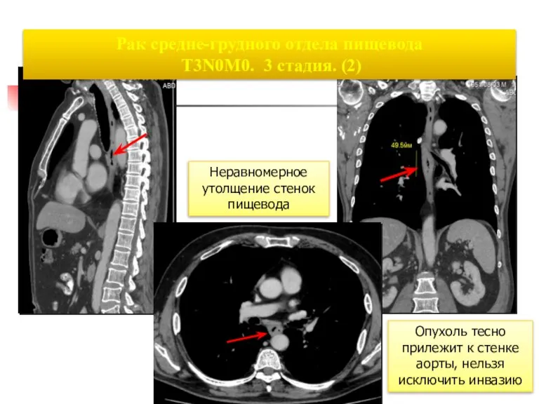 Рак средне-грудного отдела пищевода T3N0M0. 3 стадия. (2) Неравномерное утолщение стенок пищевода