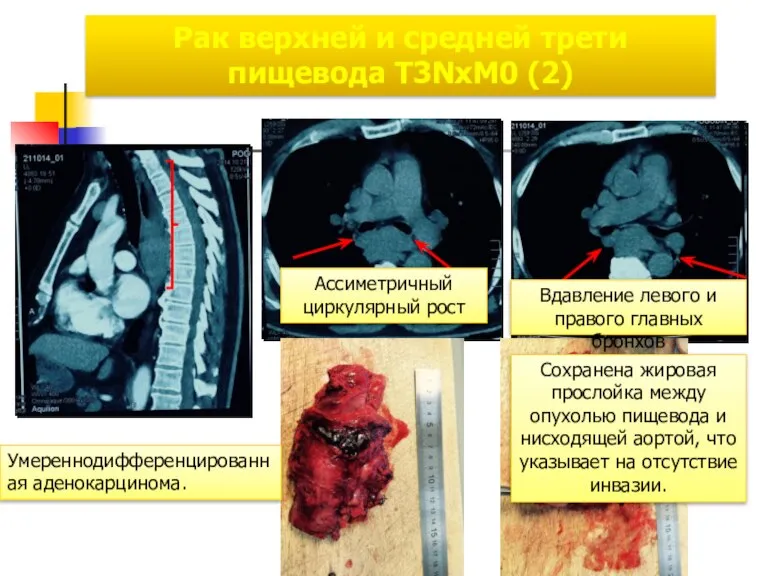 Рак верхней и средней трети пищевода Т3NxM0 (2) Умереннодифференцированная аденокарцинома. Ассиметричный циркулярный