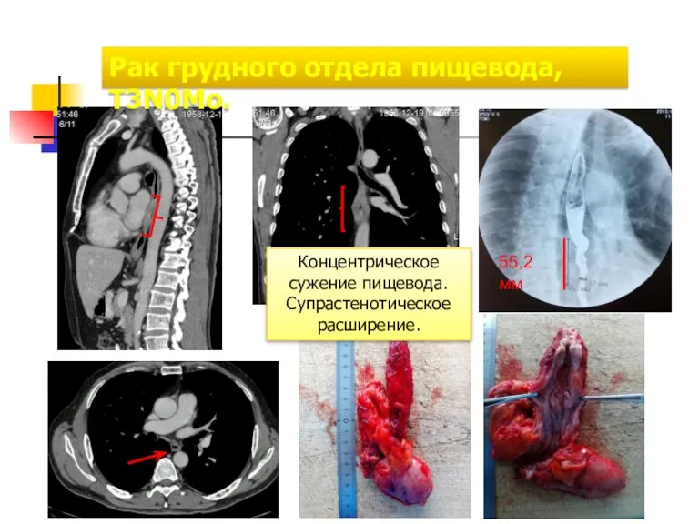 Рак грудного отдела пищевода, T3N0Mо. 55,2 мм Концентрическое сужение пищевода. Супрастенотическое расширение.