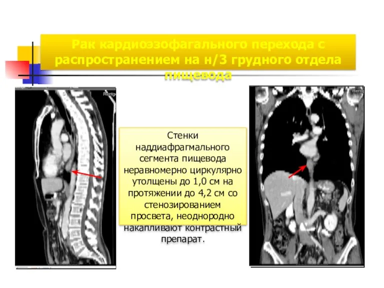 Рак кардиоэзофагального перехода с распространением на н/3 грудного отдела пищевода Стенки наддиафрагмального