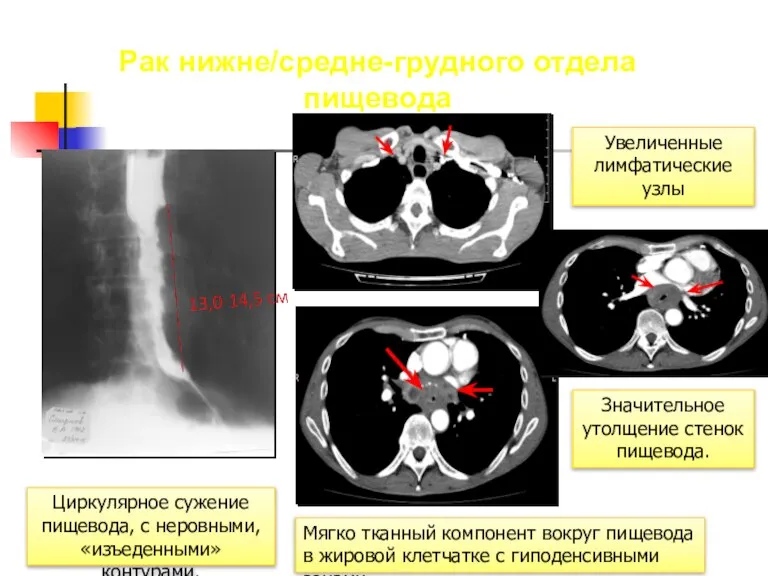 Рак нижне/средне-грудного отдела пищевода Значительное утолщение стенок пищевода. Циркулярное сужение пищевода, с