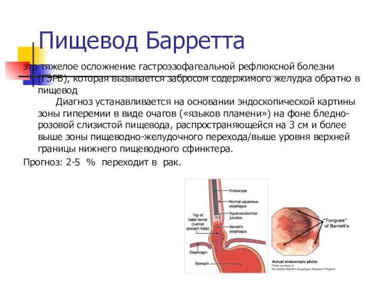 Пищевод Барретта это тяжелое осложнение гастроэзофагеальной рефлюксной болезни (ГЭРБ), которая вызывается забросом