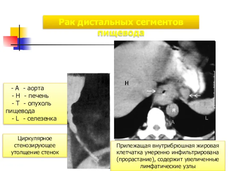 Рак дистальных сегментов пищевода - А - аорта - Н - печень