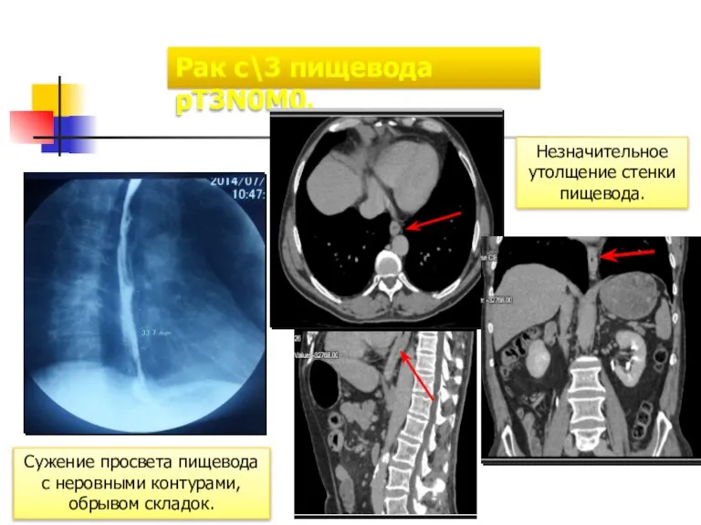 Рак с\3 пищевода pT3N0M0. Сужение просвета пищевода с неровными контурами, обрывом складок. Незначительное утолщение стенки пищевода.