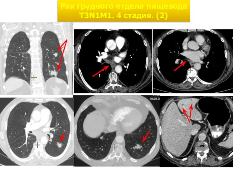 Рак грудного отдела пищевода Т3N1М1. 4 стадия. (2)