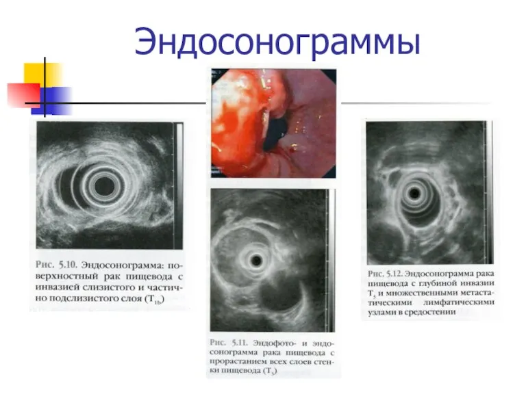 Эндосонограммы