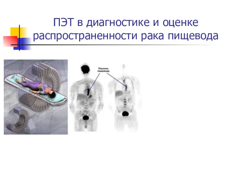 ПЭТ в диагностике и оценке распространенности рака пищевода