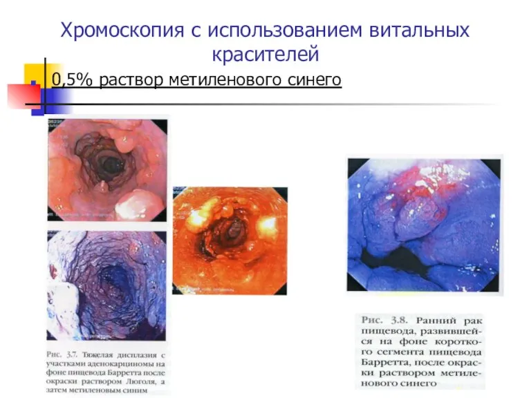 Хромоскопия с использованием витальных красителей 0,5% раствор метиленового синего