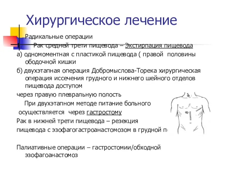 Хирургическое лечение Радикальные операции 1. Рак средней трети пищевода – Экстирпация пищевода