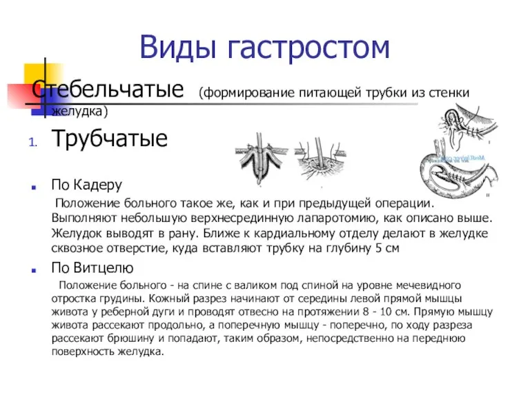 Виды гастростом Стебельчатые (формирование питающей трубки из стенки желудка) Трубчатые По Кадеру