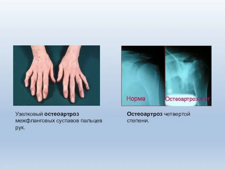 Узелковый остеоартроз межфланговых суставов пальцев рук. Остеоартроз четвертой степени.
