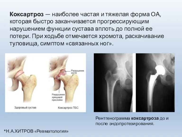 Коксартроз — наиболее частая и тяжелая форма ОА, которая быстро заканчивается прогрессирующим