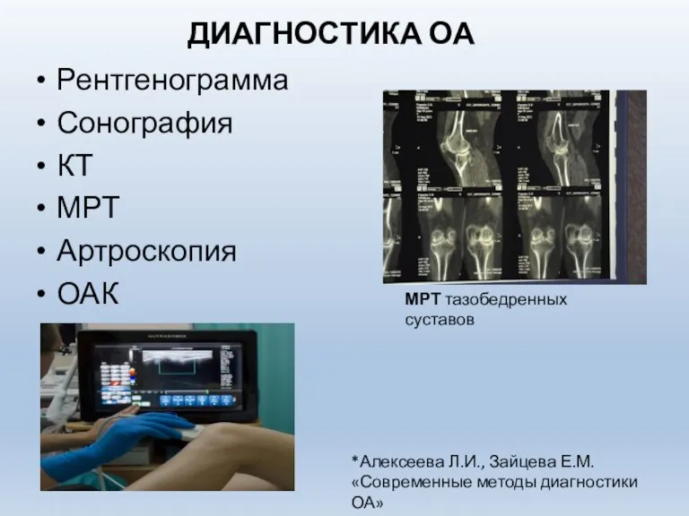 ДИАГНОСТИКА ОА Рентгенограмма Сонография КТ МРТ Артроскопия ОАК МРТ тазобедренных суставов *Алексеева