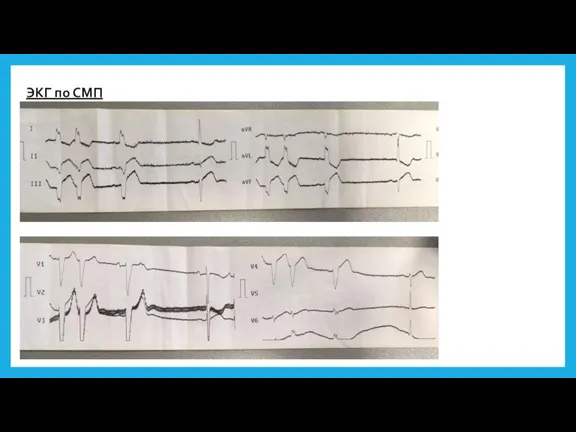 ЭКГ по СМП