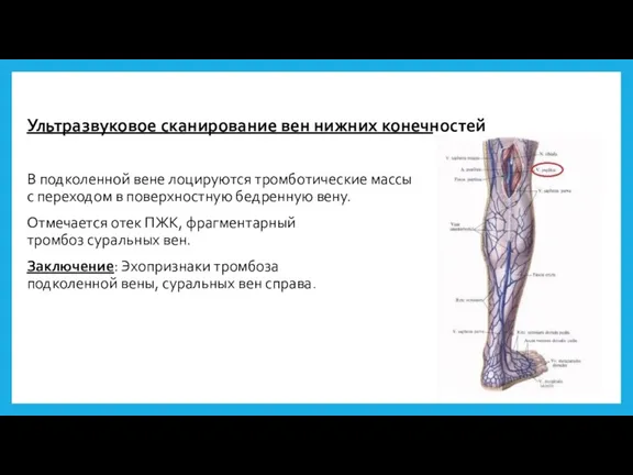 Ультразвуковое сканирование вен нижних конечностей В подколенной вене лоцируются тромботические массы с