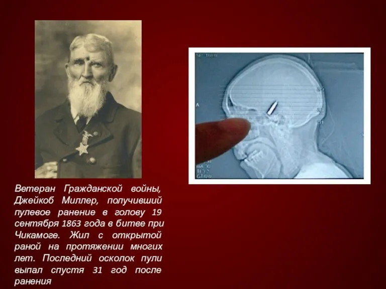 Ветеран Гражданской войны, Джейкоб Миллер, получивший пулевое ранение в голову 19 сентября