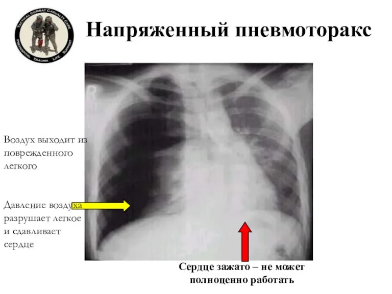 Напряженный пневмоторакс Воздух выходит из поврежденного легкого Сердце зажато – не может