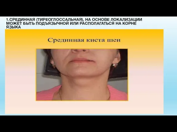 1.СРЕДИННАЯ (ТИРЕОГЛОССАЛЬНАЯ), НА ОСНОВЕ ЛОКАЛИЗАЦИИ МОЖЕТ БЫТЬ ПОДЪЯЗЫЧНОЙ ИЛИ РАСПОЛАГАТЬСЯ НА КОРНЕ ЯЗЫКА