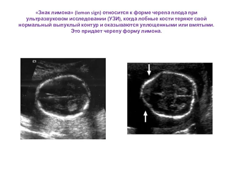 «Знак лимона» (lemon sign) относится к форме черепа плода при ультразвуковом исследовании