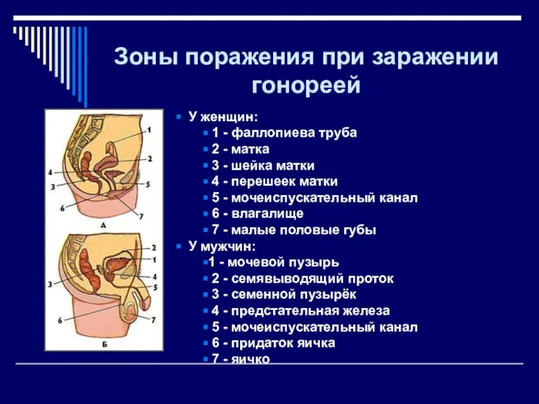 Зоны поражения при заражении гонореей У женщин: 1 - фаллопиева труба 2