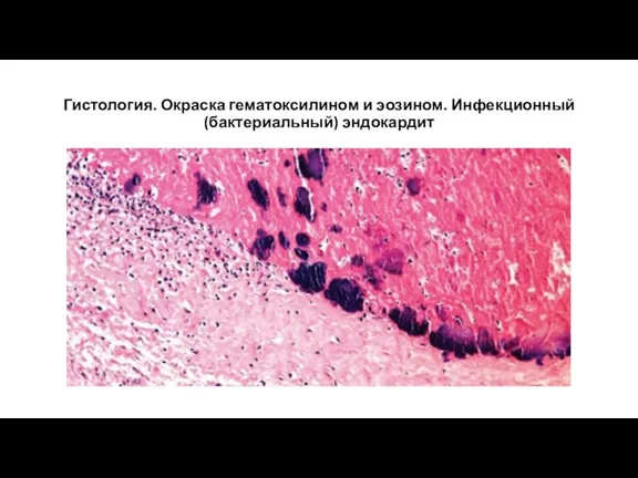 Гистология. Окраска гематоксилином и эозином. Инфекционный (бактериальный) эндокардит