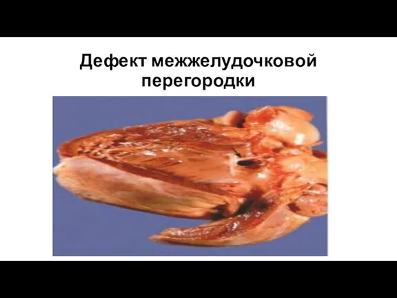 Дефект межжелудочковой перегородки