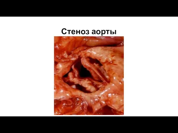 Стеноз аорты